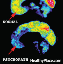 Das psychopathische Gehirn war ein Forschungsgebiet, um festzustellen, wie Psychopathen denken, aber wie unterschiedlich ist das Gehirn eines Psychopathen?