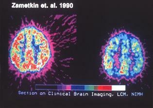 klinische bildgebende Untersuchung des Gehirns auf ADHS