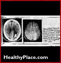 Der Neurologe John Friedberg, wie Psychopharmaka und Elektroschock das Gehirn schädigen. Er sagt, dass alle etwas Gehirnschaden und Gedächtnisverlust erleiden.